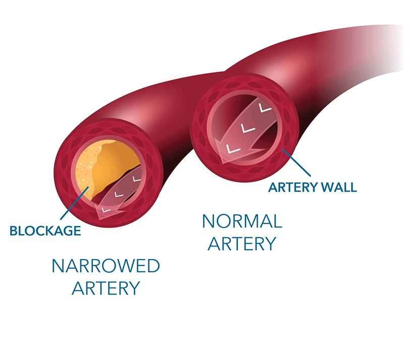 Heart Flow